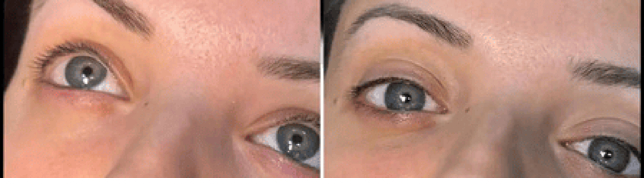 Dermal Fillers