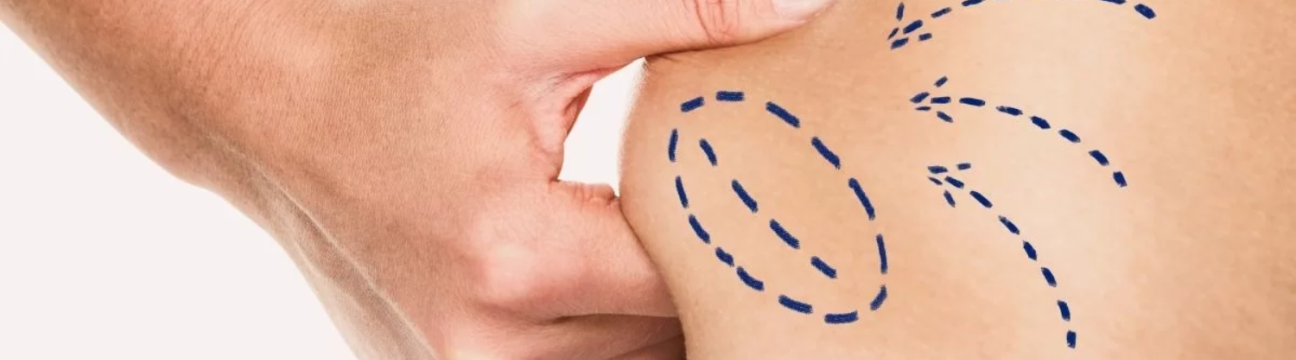 Liposuction Surgery